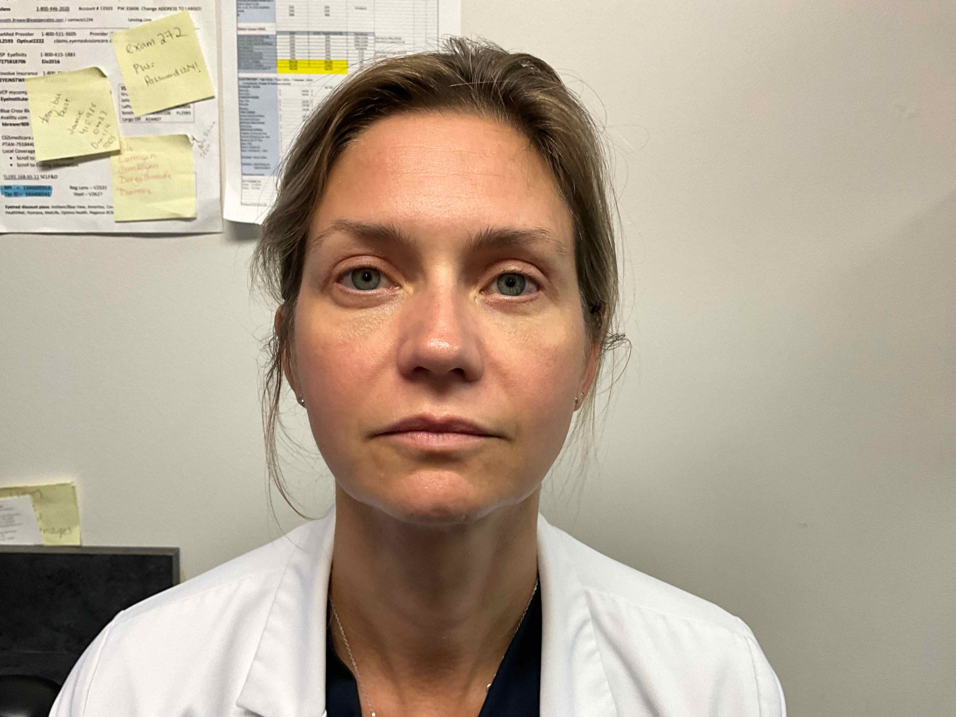 After Upper Blepharoplasty & Brow Lift