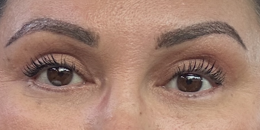 After Upper/Lower Blepharoplasty & Brow Lift